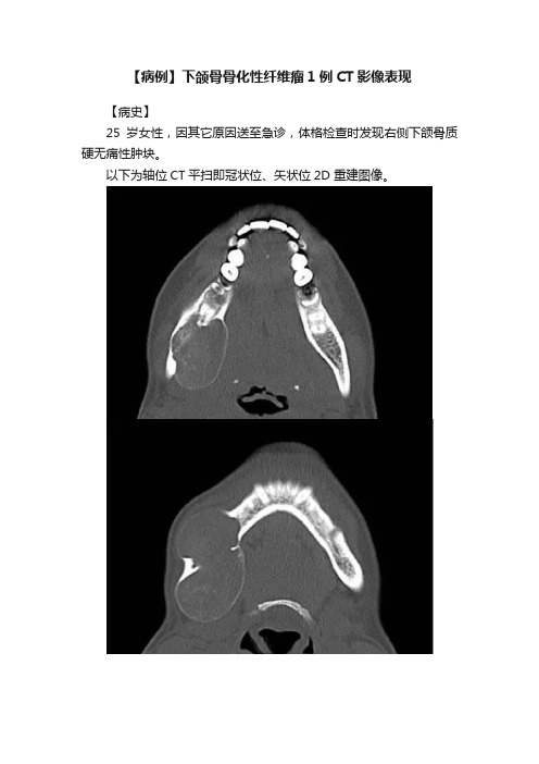 【病例】下颌骨骨化性纤维瘤1例CT影像表现