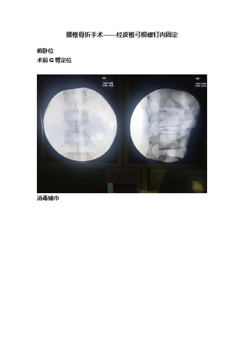 腰椎骨折手术——经皮椎弓根螺钉内固定