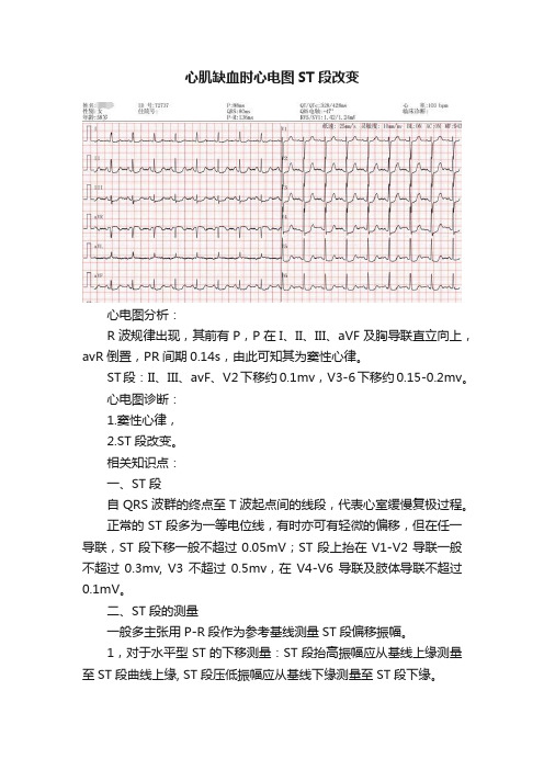 心肌缺血时心电图ST段改变