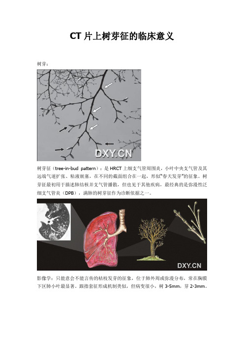 CT片上树芽征的临床意义