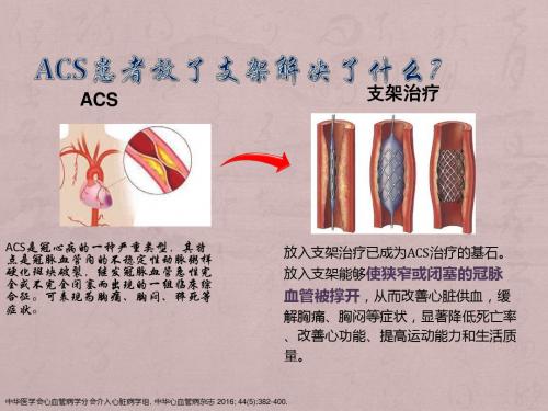 ACS患教ppt课件