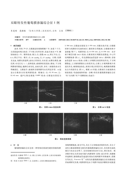 双眼特发性葡萄膜渗漏综合征1例