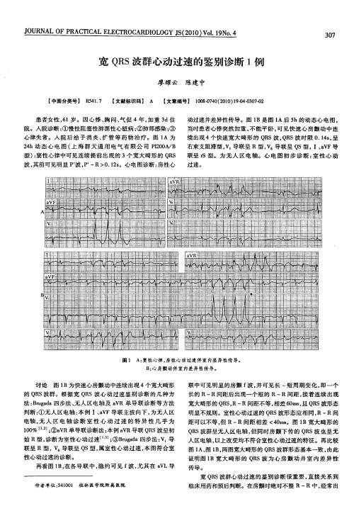 宽QRS波群心动过速的鉴别诊断1例