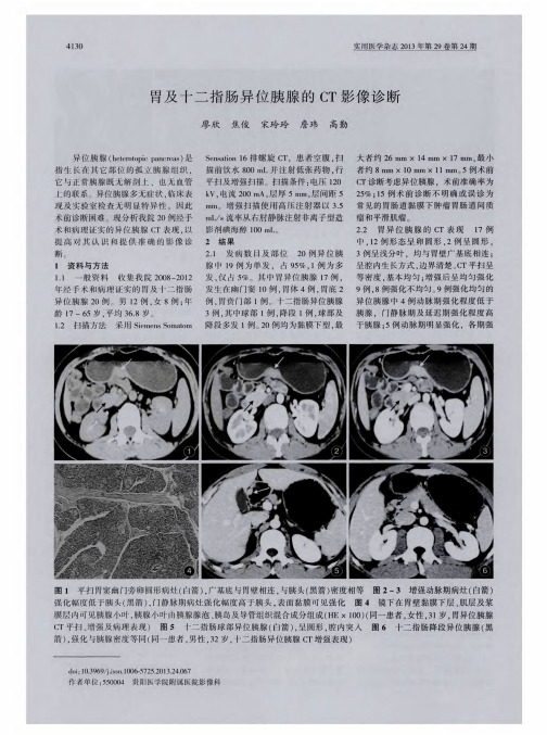 胃及十二指肠异位胰腺的CT影像诊断