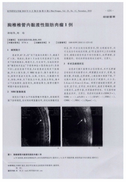 胸椎椎管内黏液性脂肪肉瘤1例