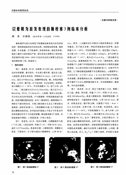 以晕厥为首发表现的肺栓塞3例临床分析