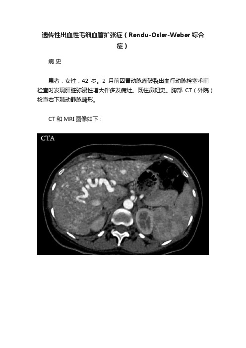 遗传性出血性毛细血管扩张症（Rendu-Osler-Weber综合症）