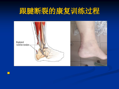 跟腱断裂的康复PPT课件