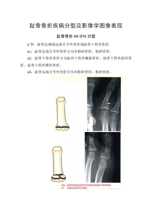 趾骨骨折疾病分型及影像学图像表现