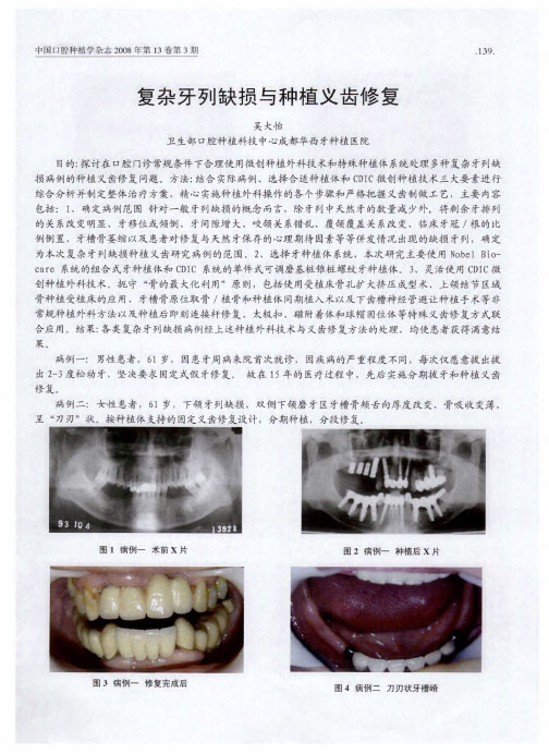 复杂牙列缺损与种植义齿修复