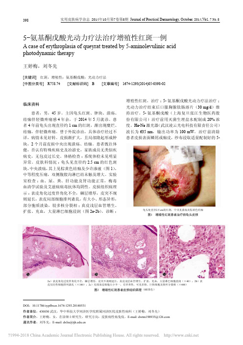 5_氨基酮戊酸光动力疗法治疗增殖性红斑一例_王婷梅