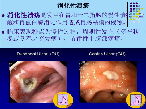 消化道溃疡revise(共28张PPT)