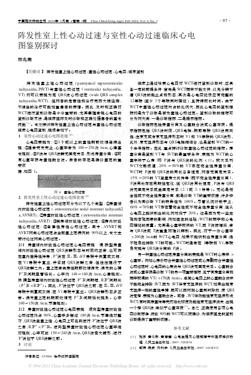 阵发性室上性心动过速与室性心动过速临床心电图鉴别探讨