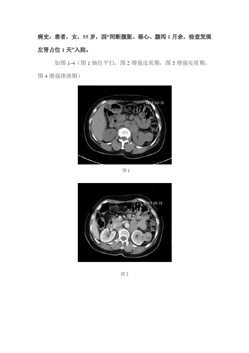 左肾下极乏血供呈抱球征占位病变--肾乳头状细胞癌