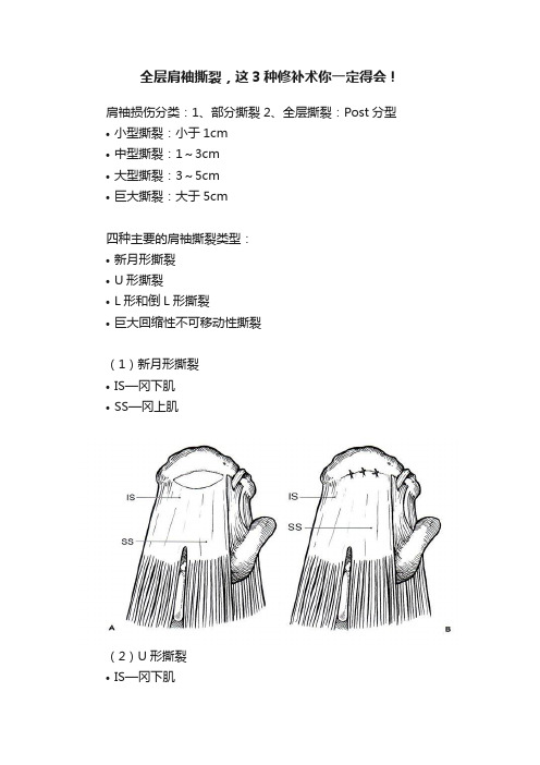 全层肩袖撕裂，这3种修补术你一定得会！