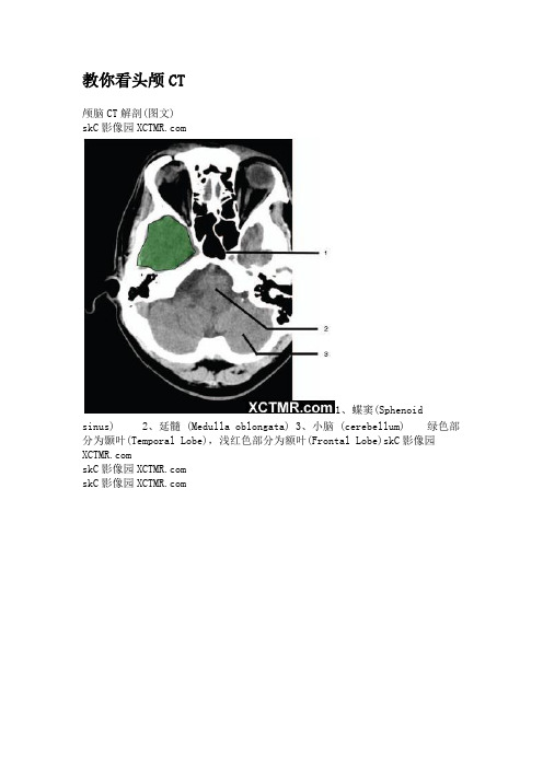 教你看头颅CT