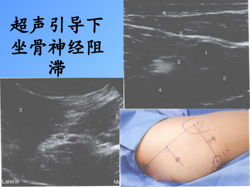 坐骨神经阻滞