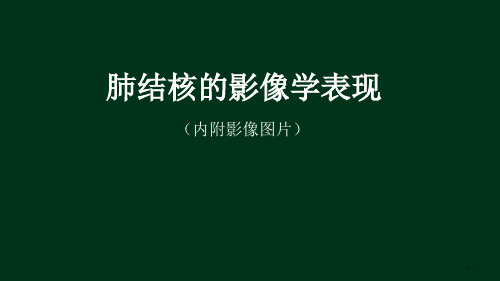 肺结核影像学表现