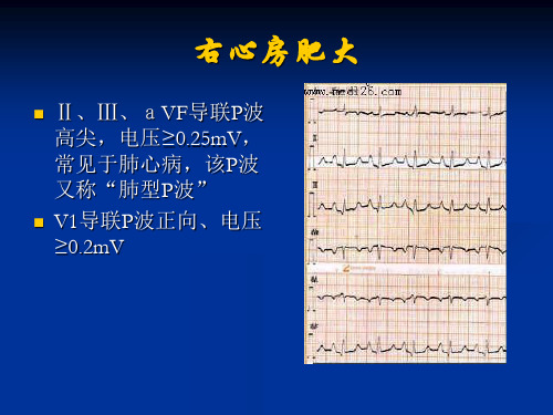 几种常见心电图表现