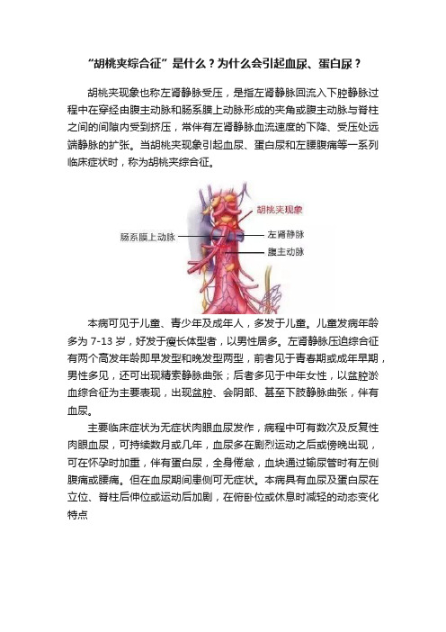 “胡桃夹综合征”是什么？为什么会引起血尿、蛋白尿？