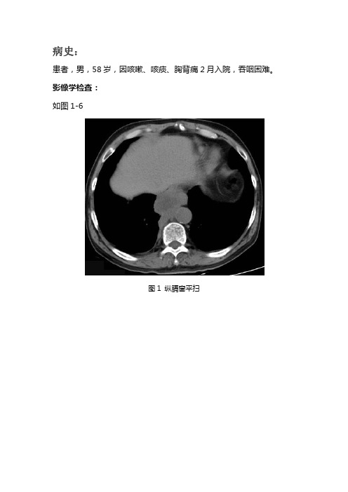 纵隔型肺癌CT诊断与鉴别