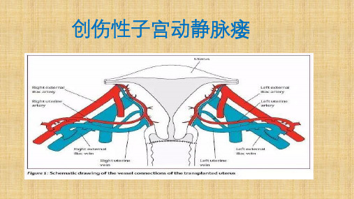 子宫动静脉瘘资料