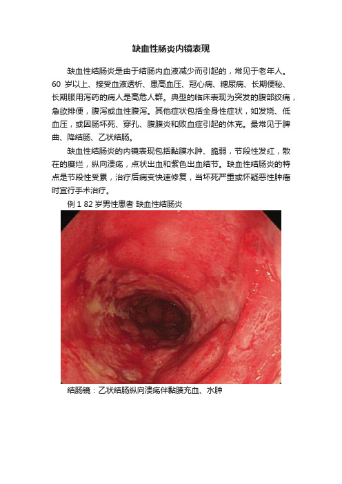 缺血性肠炎内镜表现