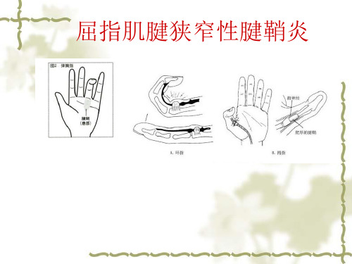 7.屈指肌腱狭窄性腱鞘炎