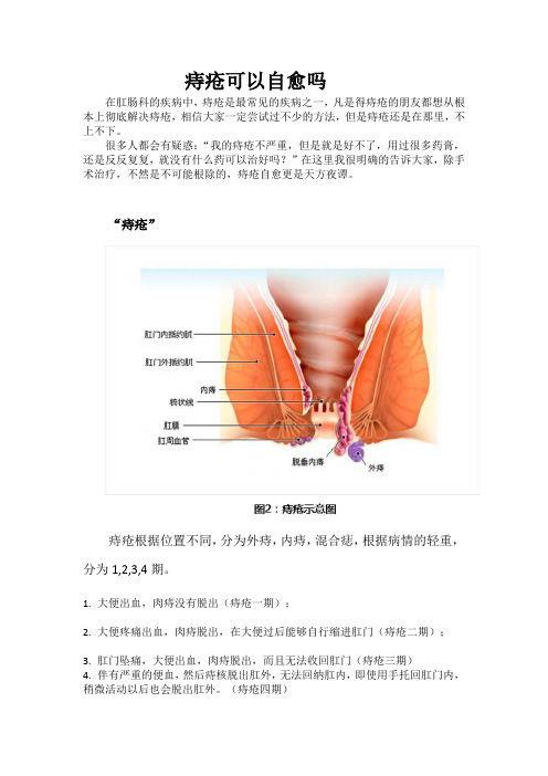 痔疮可以自愈吗？