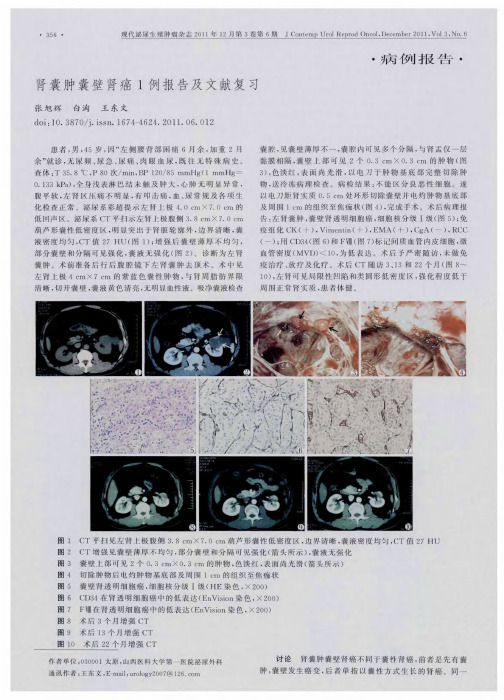 肾囊肿囊壁肾癌1例报告及文献复习