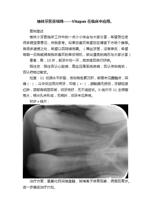 榆林牙医张瑞锋——Vitapex在临床中应用。