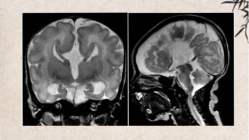 胼胝体发育不全病例解读