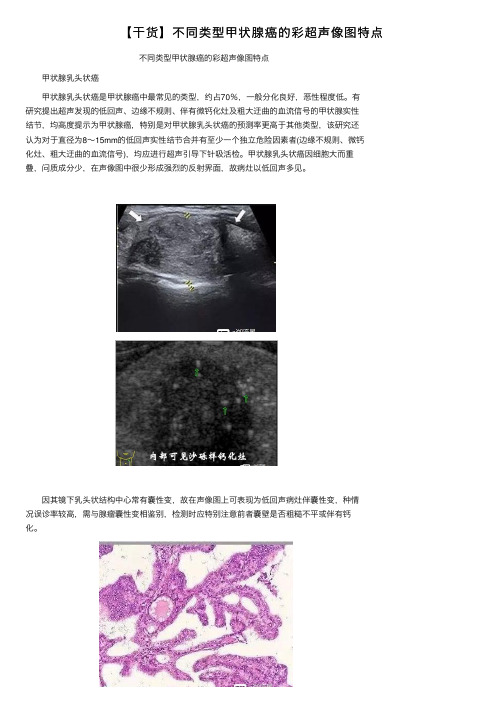 【干货】不同类型甲状腺癌的彩超声像图特点