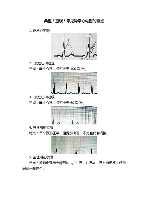 典型！直观！常见异常心电图的特点