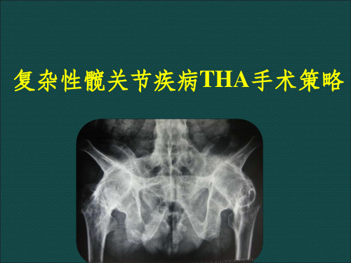 复杂性髋关节THA系列