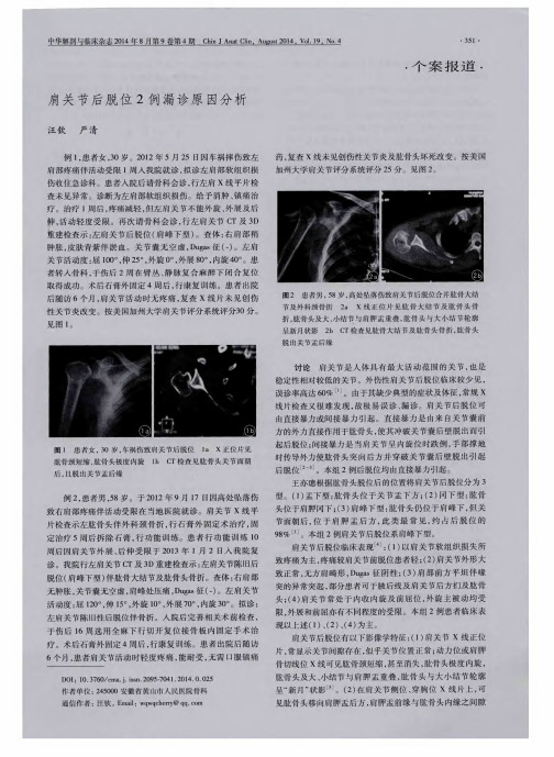 肩关节后脱位2例漏诊原因分析