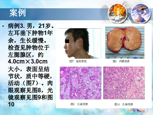 多形性腺瘤