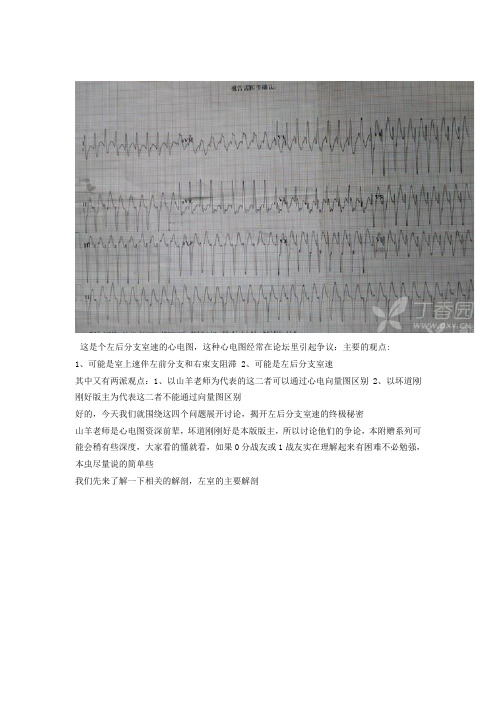 这是个左后分支室速的心电图