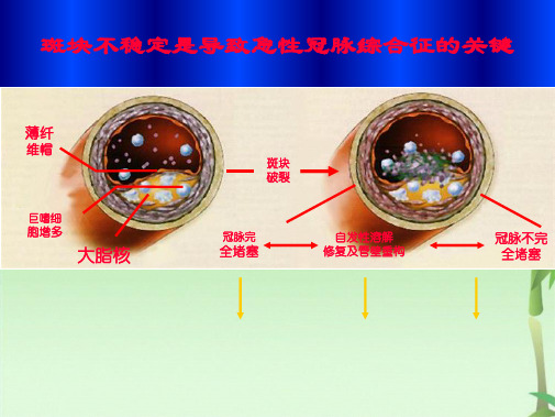 急性心肌梗死PPT课件(共28张PPT)