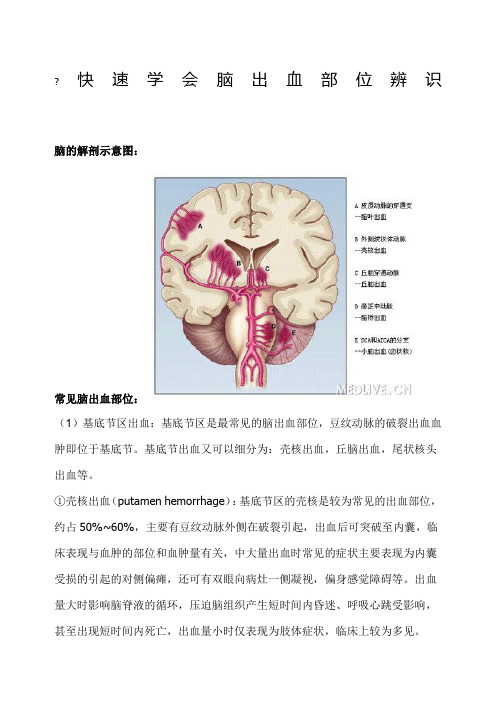 脑出血常见部位