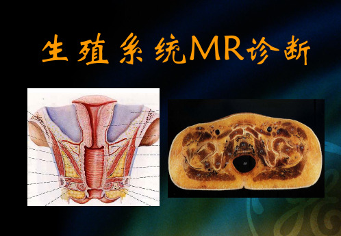 生殖系统MRI诊断