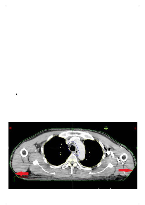 放疗计划设计的步骤与注意事项（一）