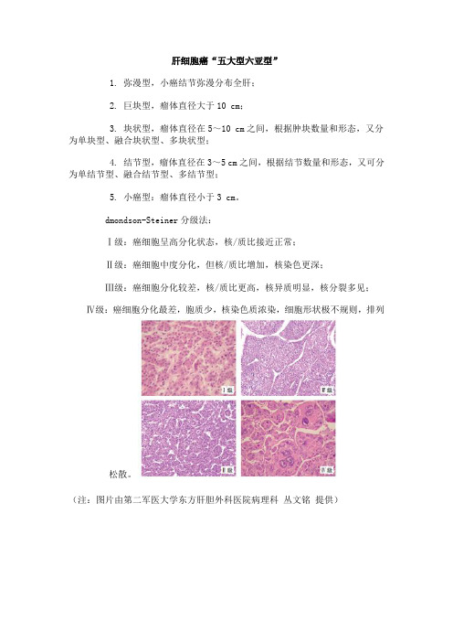 肝细胞癌“五大型六亚型”