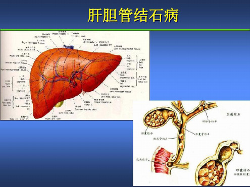 肝胆管结石病诊断治疗指南汇总_2022年学习资料
