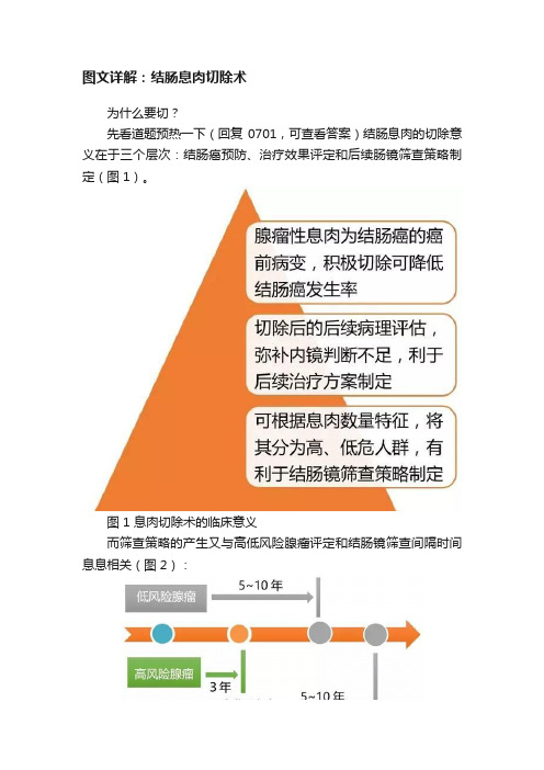 图文详解：结肠息肉切除术