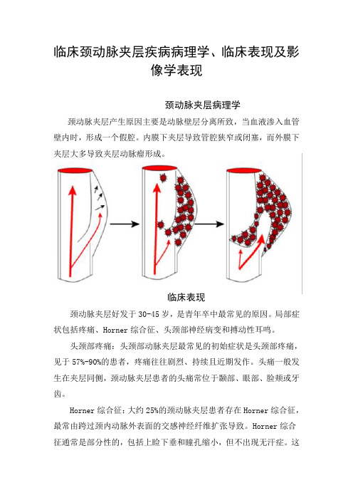 临床颈动脉夹层疾病病理学、临床表现及影像学表现