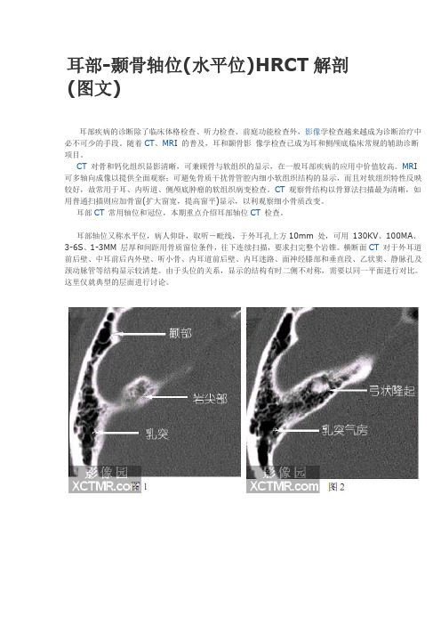 耳部-颞骨轴位(水平位)HRCT解剖