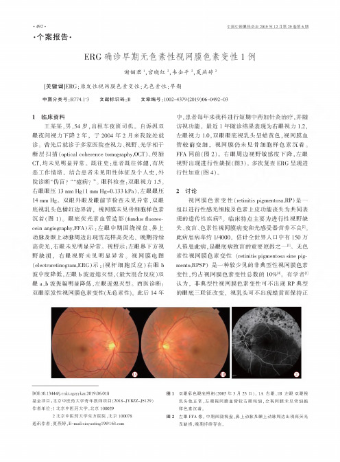 erg确诊早期无色素性视网膜色素变性1例