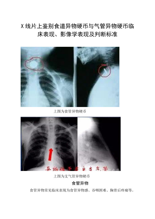 X线片上鉴别食道异物硬币与气管异物硬币临床表现、影像学表现及判断标准