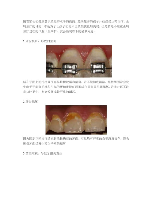 儿童正畸治疗过程中的口腔卫生保健